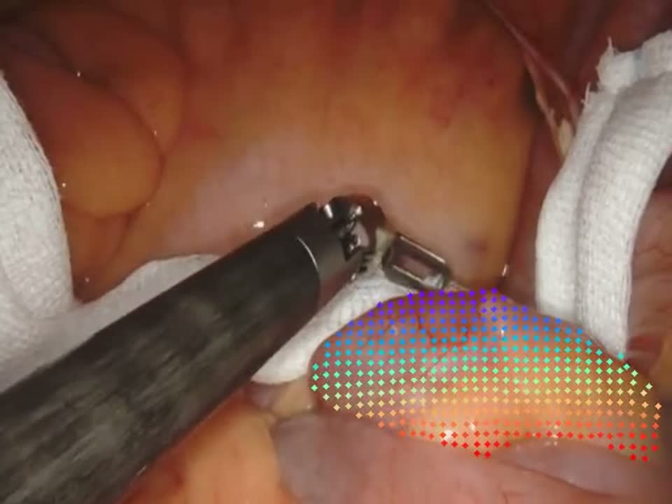 Tissue deformation tracking example