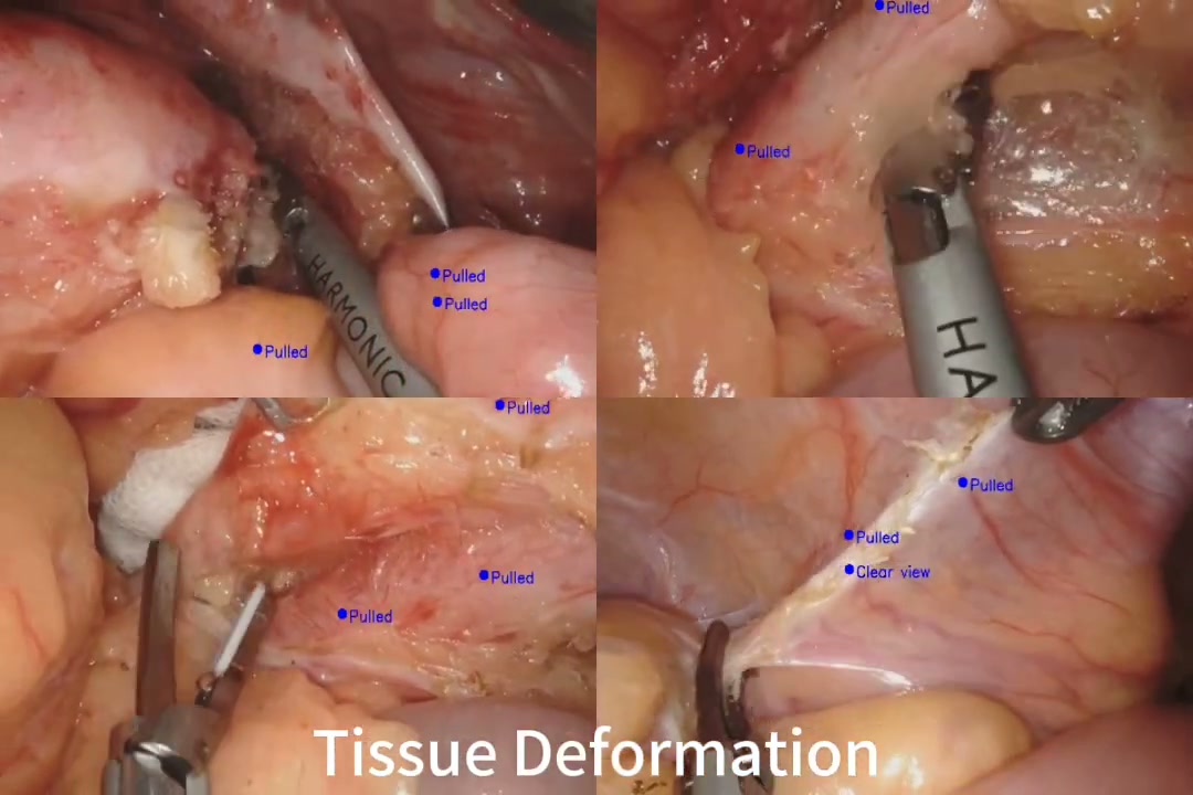 Four surgical scenes with tracked tissue points and semantic status labels